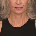 Neck Lift Before & After Patient #4143