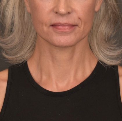 Neck Lift Before & After Patient #4143