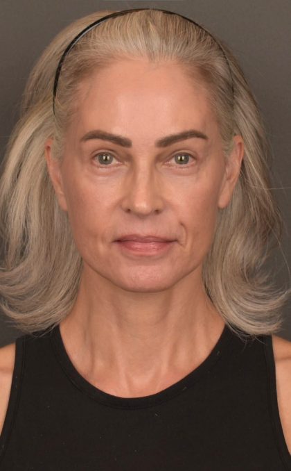 Facelift Before & After Patient #4123