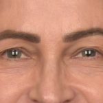 Blepharoplasty Before & After Patient #4134