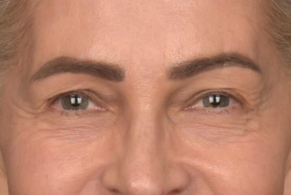 Blepharoplasty Before & After Patient #4134