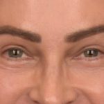 Blepharoplasty Before & After Patient #4134