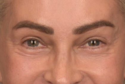 Blepharoplasty Before & After Patient #4134