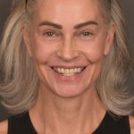 Facelift Before & After Patient #4123