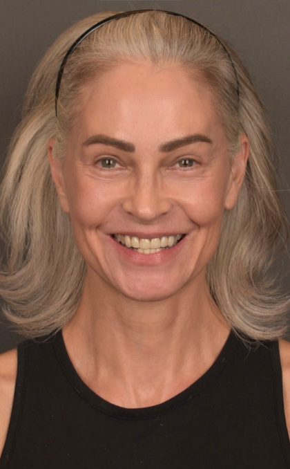 Facelift Before & After Patient #4123