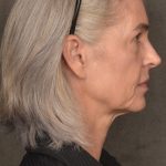 Facelift Before & After Patient #4123