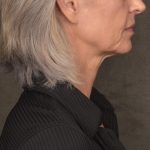 Neck Lift Before & After Patient #4143