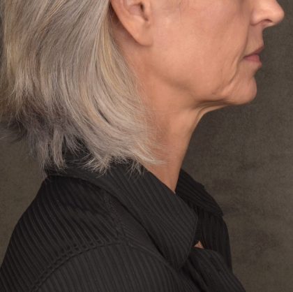 Neck Lift Before & After Patient #4143