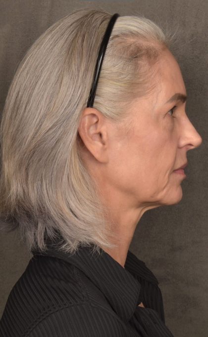 Facelift Before & After Patient #4123