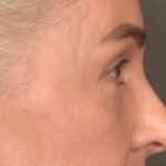 Blepharoplasty Before & After Patient #4134