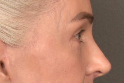 Blepharoplasty Before & After Patient #4134