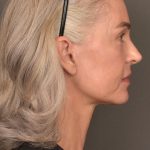 Facelift Before & After Patient #4123