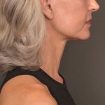 Neck Lift Before & After Patient #4143