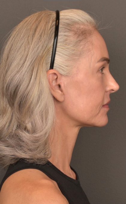 Facelift Before & After Patient #4123