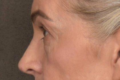 Blepharoplasty Before & After Patient #4134