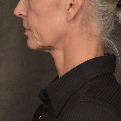Neck Lift Before & After Patient #4143