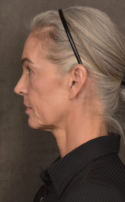 Facelift Before & After Patient #4123
