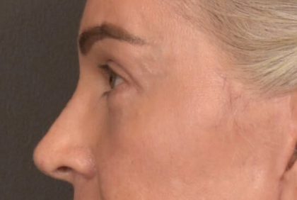 Blepharoplasty Before & After Patient #4134