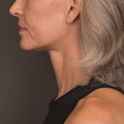 Neck Lift Before & After Patient #4143