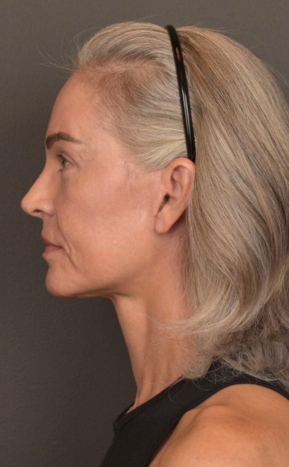 Facelift Before & After Patient #4123