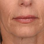 Lip Lift Before & After Patient #4165