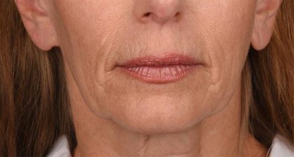 Lip Lift Before & After Patient #4165