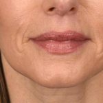 Lip Lift Before & After Patient #4165