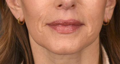 Lip Lift Before & After Patient #4165