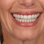 Lip Lift Before & After Patient #4165