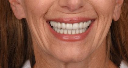 Lip Lift Before & After Patient #4165