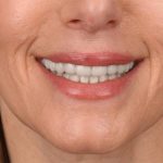 Lip Lift Before & After Patient #4165