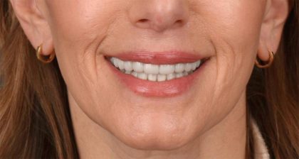 Lip Lift Before & After Patient #4165