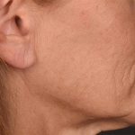 Lip Lift Before & After Patient #4165