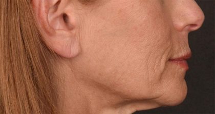 Lip Lift Before & After Patient #4165