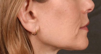 Lip Lift Before & After Patient #4165