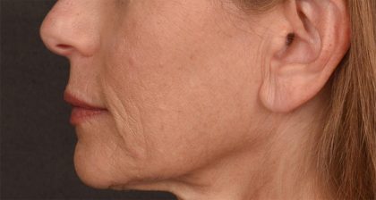 Lip Lift Before & After Patient #4165
