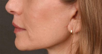 Lip Lift Before & After Patient #4165