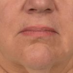 Lip Lift Before & After Patient #4169