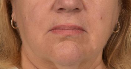 Lip Lift Before & After Patient #4169