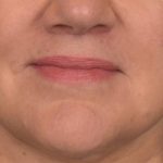 Lip Lift Before & After Patient #4169