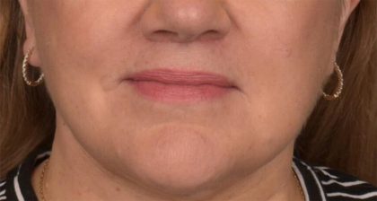 Lip Lift Before & After Patient #4169