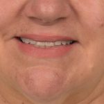 Lip Lift Before & After Patient #4169
