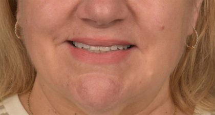 Lip Lift Before & After Patient #4169