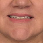 Lip Lift Before & After Patient #4169