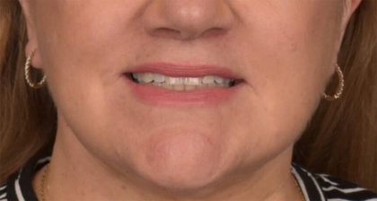 Lip Lift Before & After Patient #4169