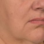 Lip Lift Before & After Patient #4169