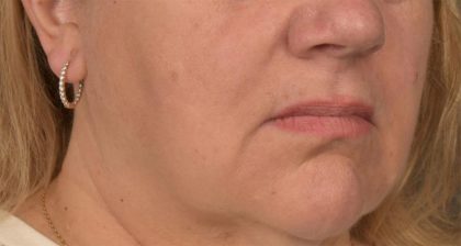 Lip Lift Before & After Patient #4169