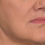 Lip Lift Before & After Patient #4169