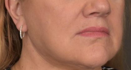 Lip Lift Before & After Patient #4169