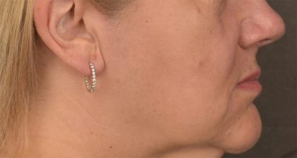 Lip Lift Before & After Patient #4169